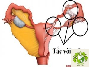 Đau bụng dưới bên trái là dấu hiệu của bệnh gì?
