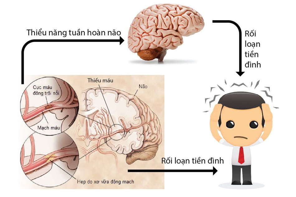 Phân biệt Thiểu năng tuần hoàn não và Rối loạn tiền đình