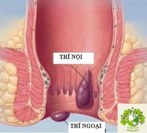 bệnh trĩ
