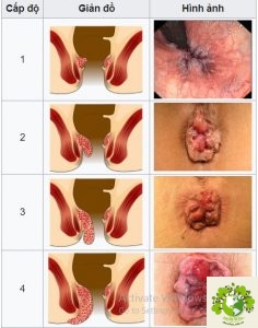 các mức độ của bệnh trĩ
