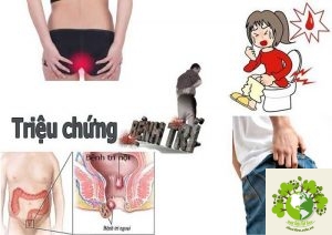 triệu chứng bệnh trĩ