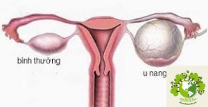 Đau bụng dưới bên trái ở nữ