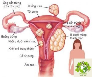 Đau bụng dưới bên trái là dấu hiệu của bệnh gì?